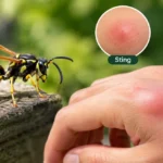 Does Wasps Bite or Sting
